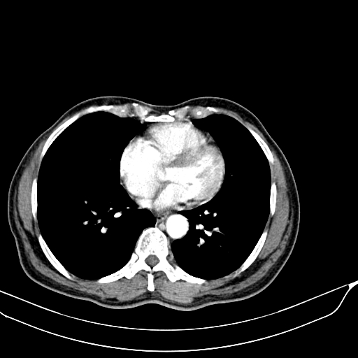 File:Acute pulmonary embolism (Radiopaedia 69510-79390 D 48).jpg