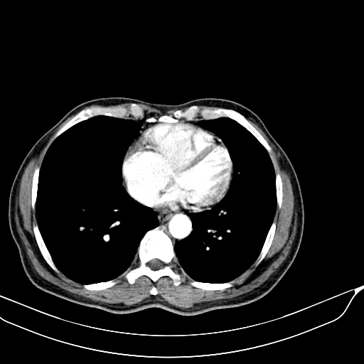 Acute pulmonary embolism (Radiopaedia 69510-79390 D 54).jpg