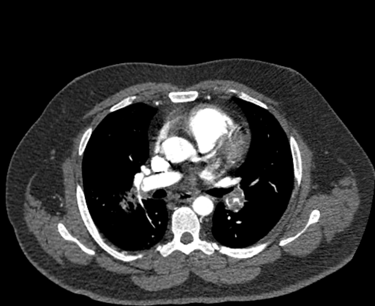 Acute pulmonary embolism with pulmonary infarcts (Radiopaedia 77688-89908 Axial C+ CTPA 29).jpg