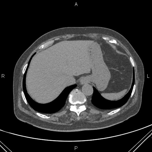 Acute renal artery occlusion (Radiopaedia 86586-102682 Axial non-contrast 8).jpg