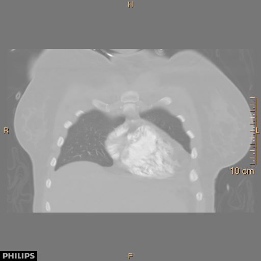 File:Acute reversible pulmonary hypertension and right heart failure from cocaine toxicity (Radiopaedia 49394-54517 Coronal 19).jpg