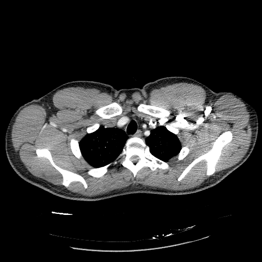 File:Acute segmental pulmonary emboli and pulmonary infarction (Radiopaedia 62264-70444 Axial C+ CTPA 20).jpg