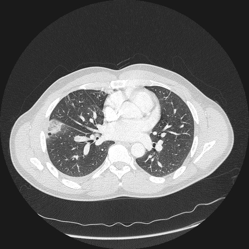 Acute segmental pulmonary emboli and pulmonary infarction (Radiopaedia 62264-70444 Axial lung window 101).jpg