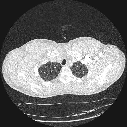 File:Acute segmental pulmonary emboli and pulmonary infarction (Radiopaedia 62264-70444 Axial lung window 17).jpg