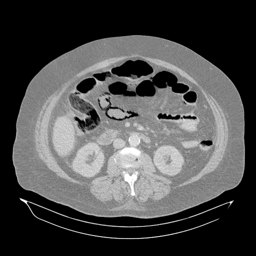 File:Acute superior mesenteric artery occlusion (Radiopaedia 51288-56960 Axial lung window 28).jpg