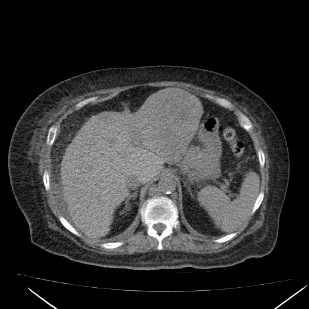 Acute tubular necrosis (Radiopaedia 28077-28334 Axial non-contrast 18).jpg