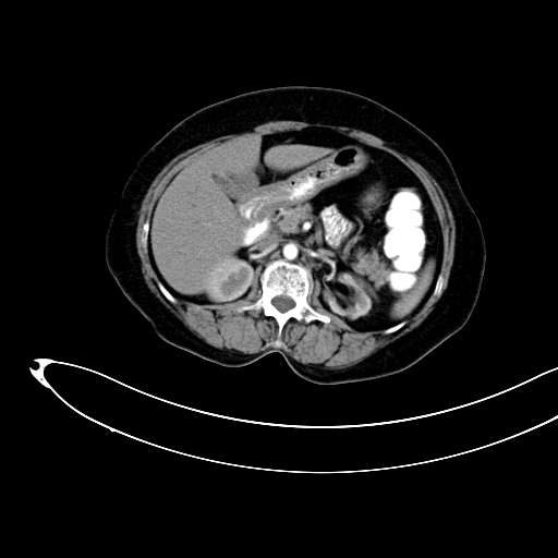 File:Adenocarcinoma colon with intussusception (Radiopaedia 86006-101922 Axial C+ arterial phase 18).jpg