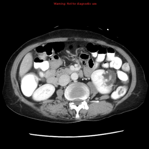 Adenocarcinoma of the colon (Radiopaedia 8191-9039 Axial liver window 35).jpg