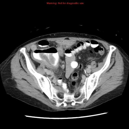 File:Adenocarcinoma of the colon (Radiopaedia 8191-9039 Axial renal excretory phase 45).jpg