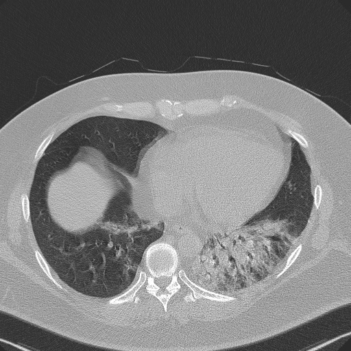 Adenoid cystic carcinoma of the trachea (Radiopaedia 49042-54137 Axial lung window 248).jpg