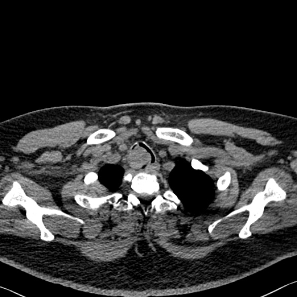 Adenoid cystic carcinoma of the trachea (Radiopaedia 49042-54137 Axial non-contrast 28).jpg
