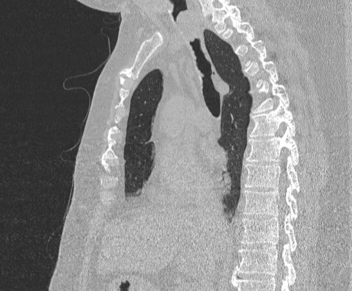 File:Adenoid cystic carcinoma of the trachea (Radiopaedia 49042-54137 Sagittal lung window 218).jpg