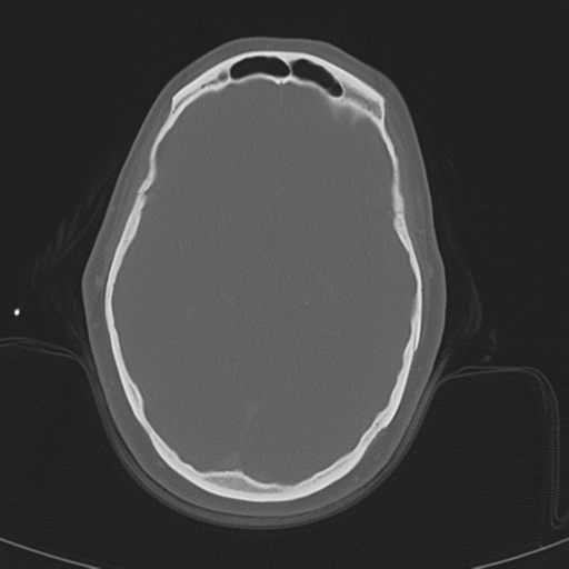 File:Adenoid cystic tumor of palate (Radiopaedia 46980-51518 Axial bone window 5).png