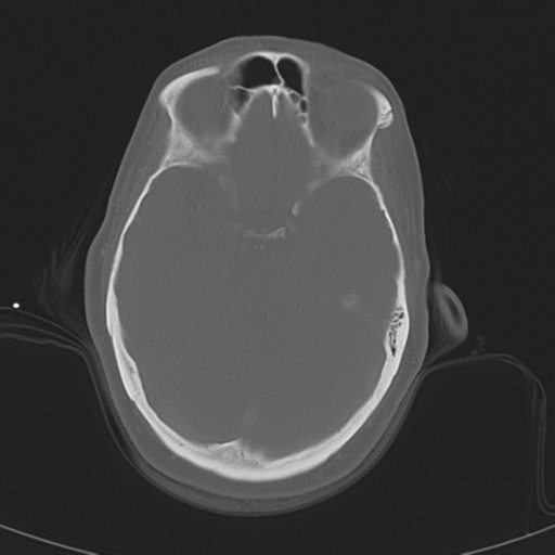 File:Adenoid cystic tumor of palate (Radiopaedia 46980-51518 Axial bone window 9).png