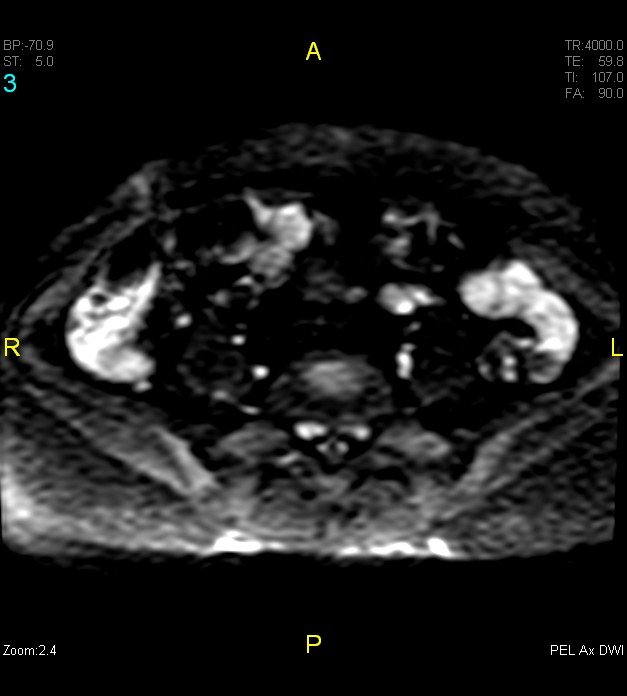 Adenomyosis (Radiopaedia 43504-46889 Axial DWI 3).jpg