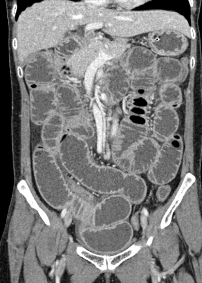 Adhesional small bowel obstruction (Radiopaedia 48397-53305 Coronal C+ portal venous phase 144).jpg