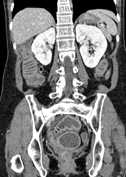 Adhesional small bowel obstruction (Radiopaedia 48397-53305 Coronal C+ portal venous phase 238).jpg