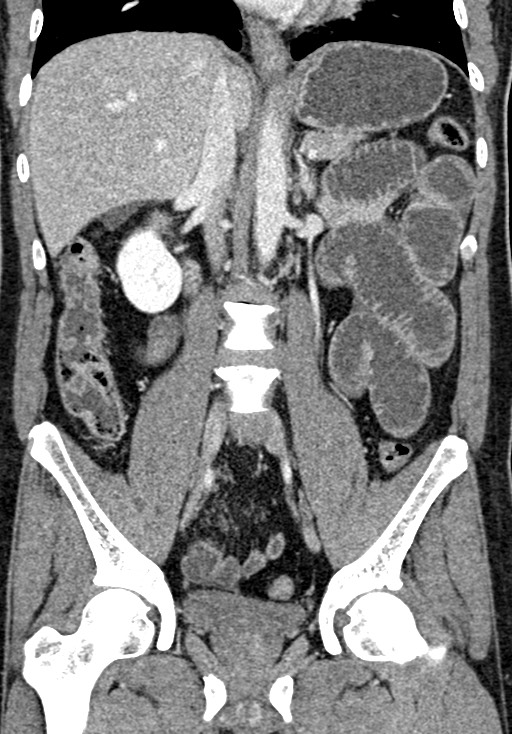 Adhesional small bowel obstruction (Radiopaedia 58900-66131 Coronal C+ portal venous phase 149).jpg