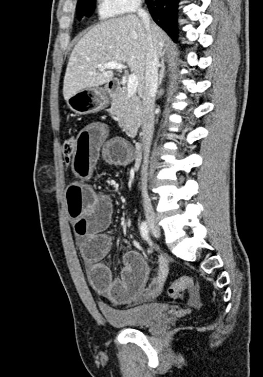 Adhesional small bowel obstruction (Radiopaedia 58900-66131 Sagittal C+ portal venous phase 108).jpg