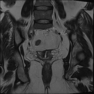 File:Adnexal multilocular cyst (O-RADS US 3- O-RADS MRI 3) (Radiopaedia 87426-103754 Coronal T2 21).jpg