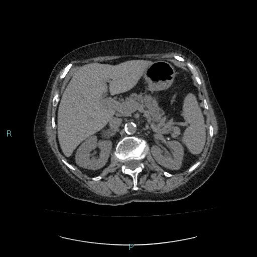 File:Adrenal collision tumor (ACT) (Radiopaedia 48462-53379 Axial non-contrast 17).jpg