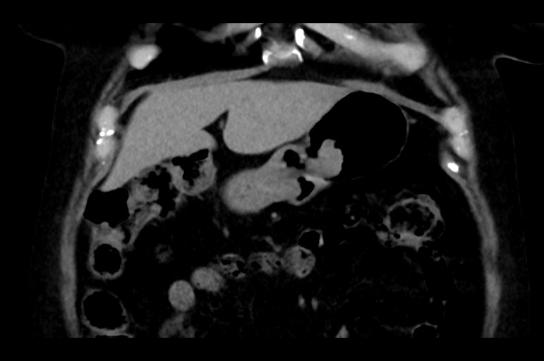 Adrenal cortical carcinoma (Radiopaedia 64017-72769 Coronal non-contrast 14).jpg