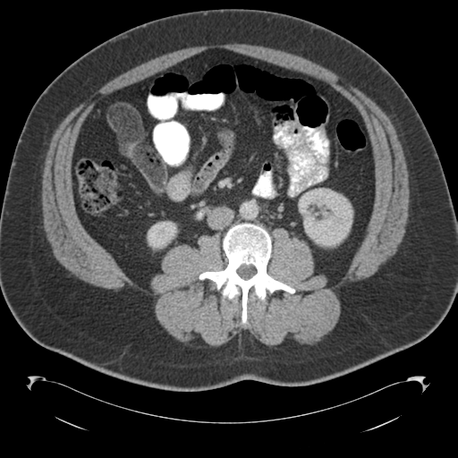 File:Adrenal cyst (Radiopaedia 45625-49776 Axial C+ portal venous phase 50).png