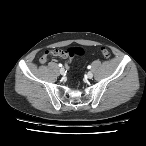 Adrenal gland trauma (Radiopaedia 81351-95078 Axial Dual bolus trauma C+ 103).jpg
