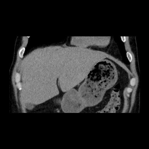 Adrenal gland trauma (Radiopaedia 81351-95079 Coronal non-contrast 23).jpg