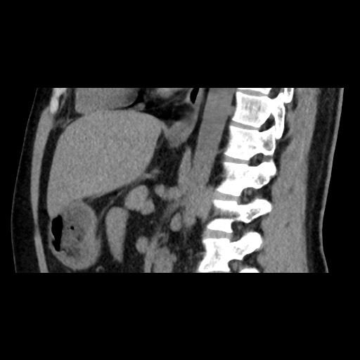 File:Adrenal gland trauma (Radiopaedia 81351-95079 Sagittal non-contrast 56).jpg