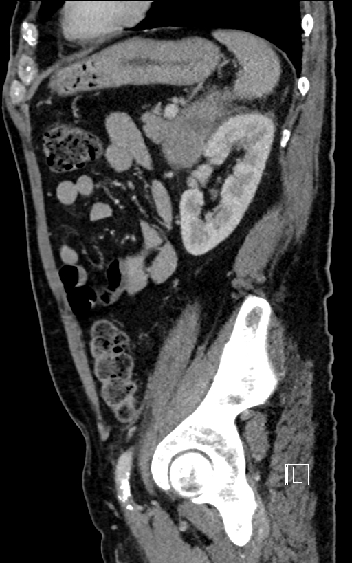 Adrenal lymphoma (Radiopaedia 73730-84529 Sagittal C+ portal venous phase 80).jpg