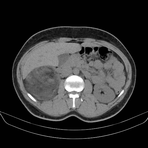 Adrenal myelolipoma - bilateral (Radiopaedia 74805-85810 Axial non-contrast 31).jpg