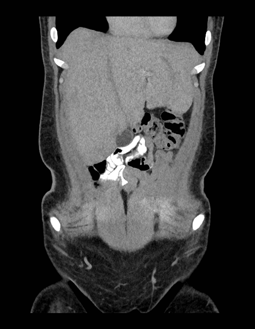 Adrenal myelolipoma - bilateral (Radiopaedia 74805-85810 Coronal C+ portal venous phase 215).jpg