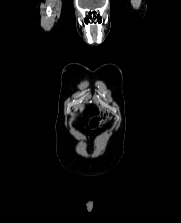 Adrenocortical carcinoma (Radiopaedia 80134-93438 Coronal C+ portal venous phase 17).jpg
