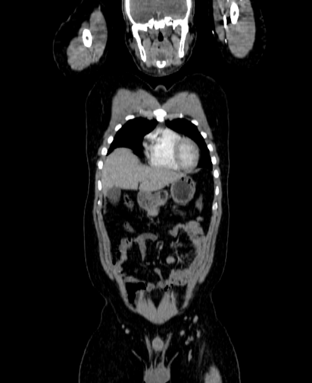 Adrenocortical carcinoma (Radiopaedia 80134-93438 Coronal C+ portal venous phase 45).jpg