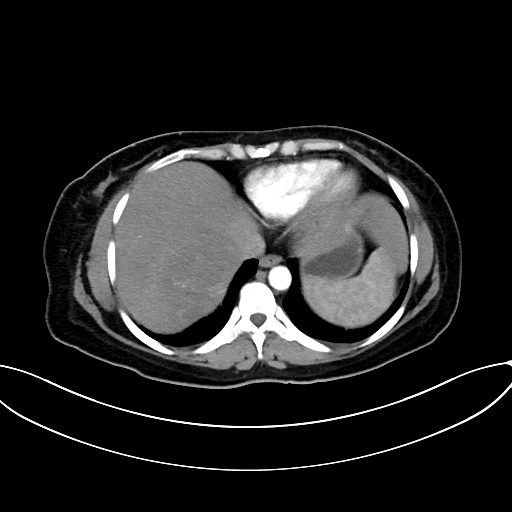 Adrenocortical carcinoma (Radiopaedia 87281-103569 Axial C+ arterial phase 13).jpg