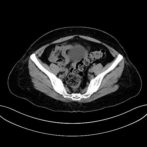 Adrenocortical carcinoma (Radiopaedia 87281-103569 Axial non-contrast 70).jpg