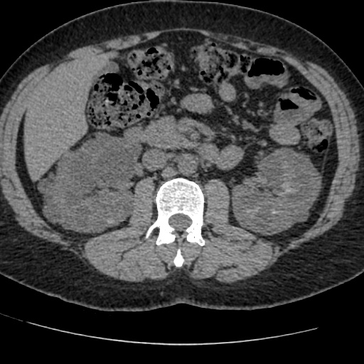 Adult polycystic kidney disease (Radiopaedia 59075-66368 Axial non-contrast 33).jpg