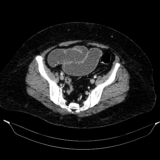 File:Afferent loop syndrome - secondary to incarcerated trocar site hernia (Radiopaedia 82959-97305 Axial C+ portal venous phase 189).jpg