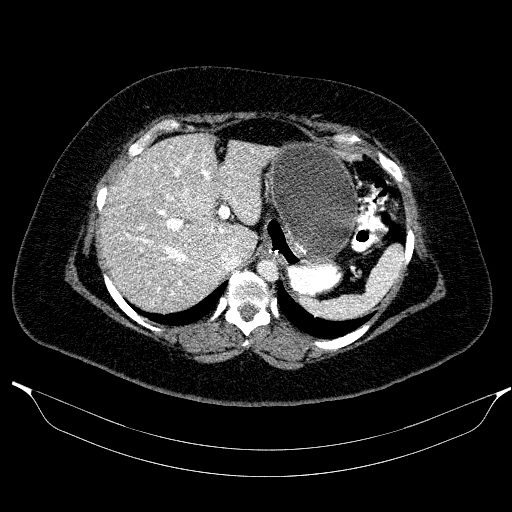 Afferent loop syndrome - secondary to incarcerated trocar site hernia (Radiopaedia 82959-97305 Axial C+ portal venous phase 52).jpg