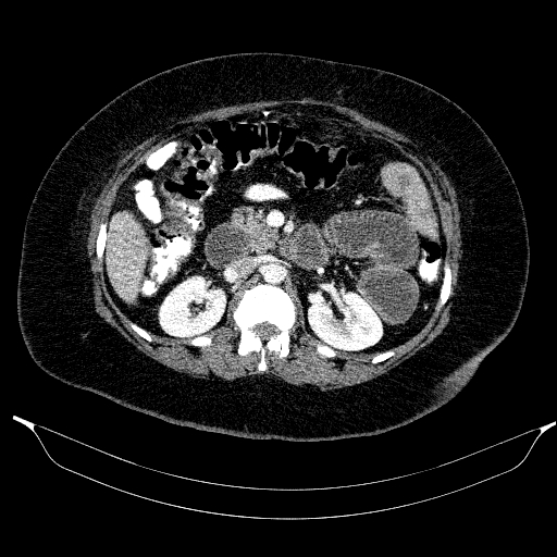 Afferent loop syndrome - secondary to incarcerated trocar site hernia (Radiopaedia 82959-97305 Axial C+ portal venous phase 93).jpg
