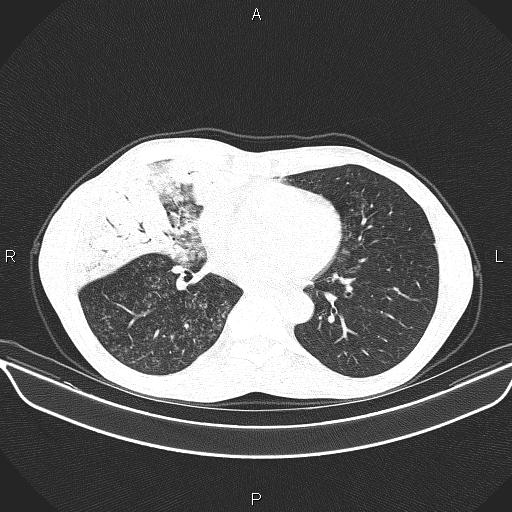 Air bronchogram in pneumonia (Radiopaedia 85719-101512 Axial lung window 41).jpg