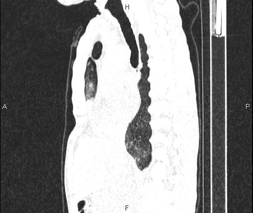 Air bronchogram in pneumonia (Radiopaedia 85719-101512 Sagittal lung window 47).jpg