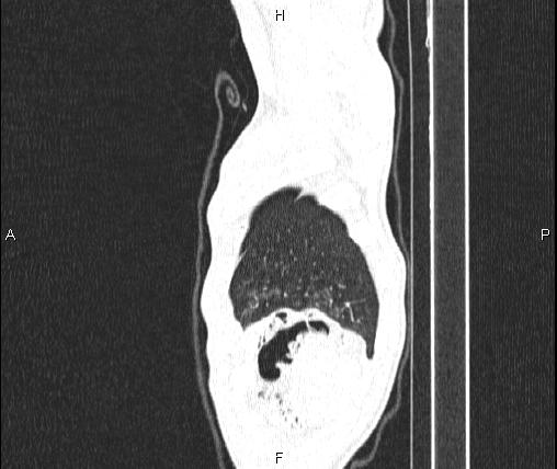 Air bronchogram in pneumonia (Radiopaedia 85719-101512 Sagittal lung window 97).jpg