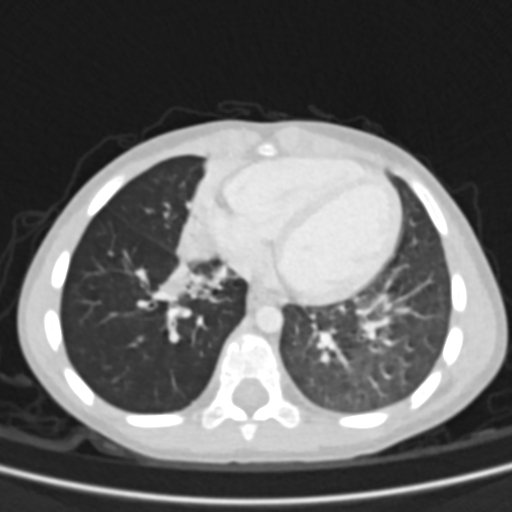 Airway foreign body (Radiopaedia 72128-82638 Axial lung window 61).jpg
