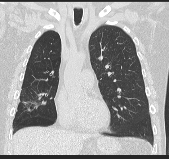 Allergic bronchopulmonary aspergillosis (Radiopaedia 44760-48571 Coronal lung window 24).png