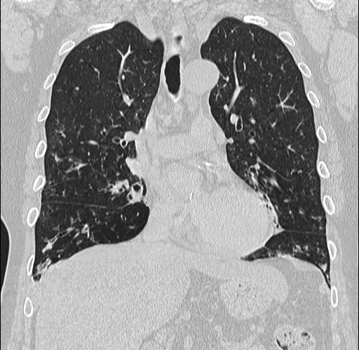 Alpha-1-antitrypsin deficiency (Radiopaedia 72058-82557 Coronal lung window 34).jpg
