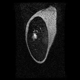 Alveolar soft part sarcoma (Radiopaedia 64501-73678 D 127).jpg