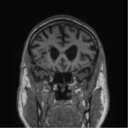 Alzheimer's disease- with Gerstmann syndrome and dressing apraxia (Radiopaedia 54882-61150 Coronal T1 65).png
