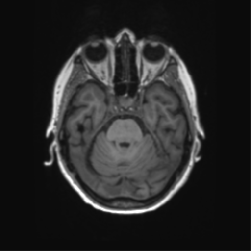 File:Alzheimer's disease (Radiopaedia 42658-45802 Axial T1 107).png